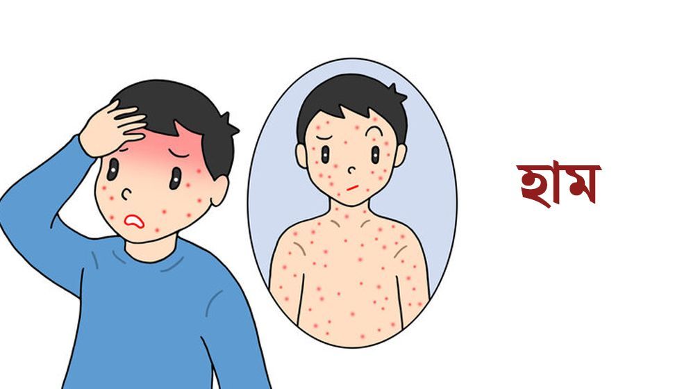 তিন লাখ শিশুকে হাম-রুবেলার টিকা দেওয়া হবে: চসিক মেয়র